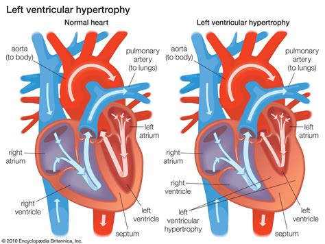 Right Ventricular Dysfunction .